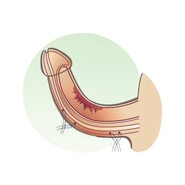 Corporoplastia tipo Plicaturas